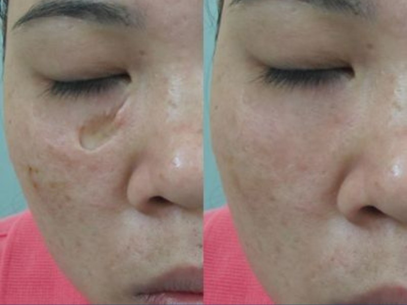 xóa sẹo lõm bằng laser - 3