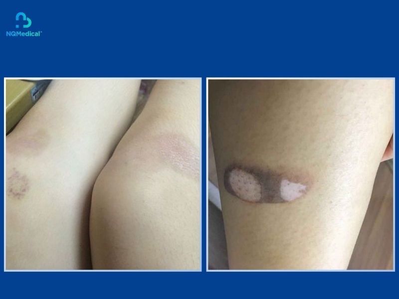 xóa sẹo phỏng bô bằng laser-2