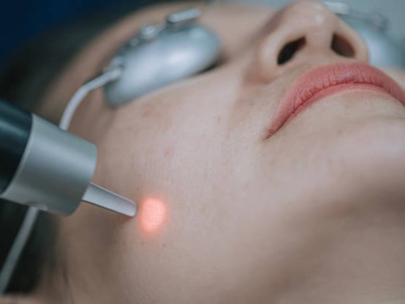 Xóa tàn nhang bằng laser bao nhiêu tiền - 1