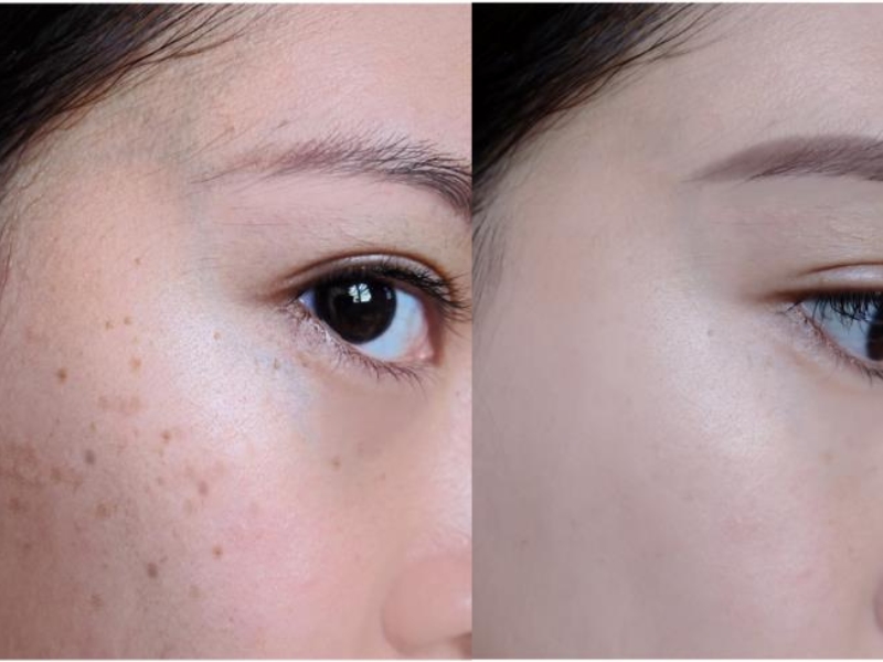 Xóa tàn nhang bằng laser bao nhiêu tiền - 4