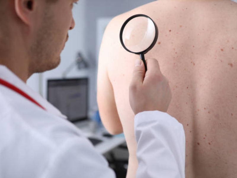 Xóa tàn nhang bằng laser bao nhiêu tiền - 5