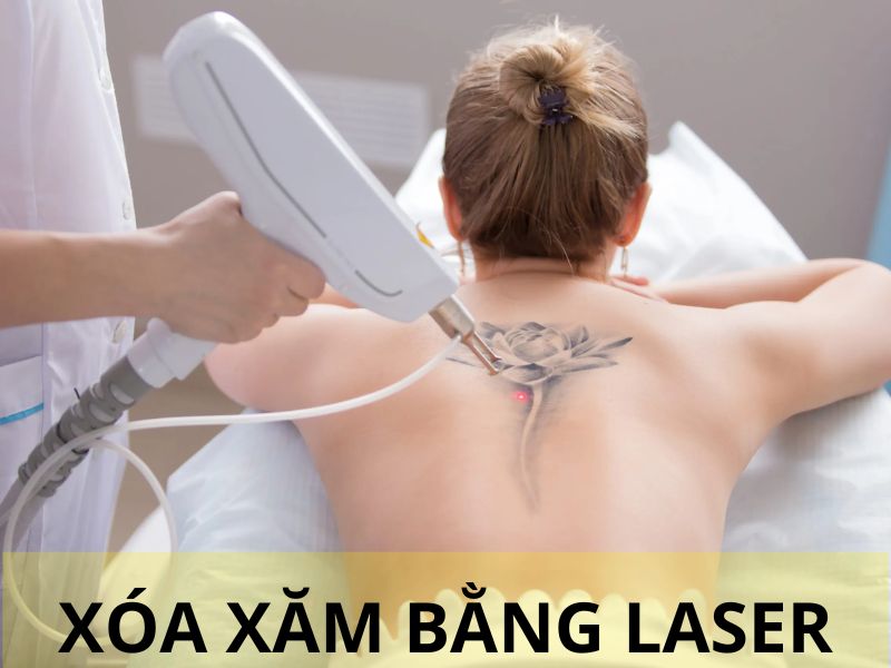 Xóa xăm bằng Laser -1