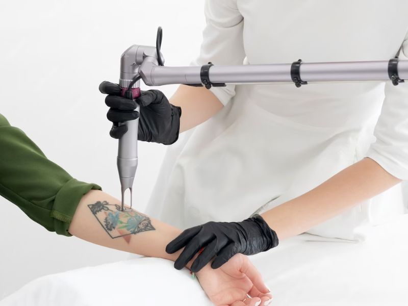 xóa xăm bằng laser - 11 xóa xăm bằng laser - 11