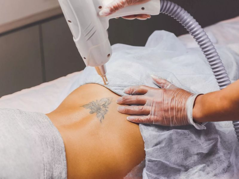 Xóa xăm bằng laser - 2 Xóa xăm bằng laser - 2