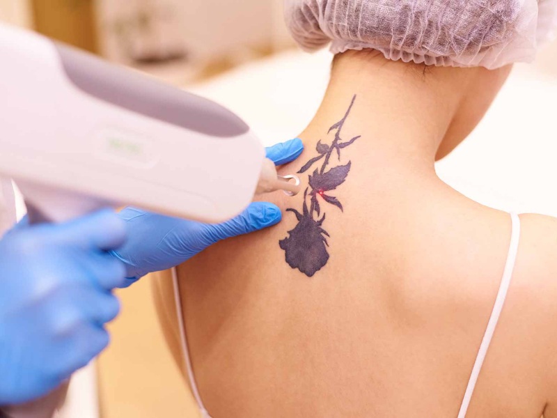 Xóa xăm bằng laser có để lại sẹo không - 1