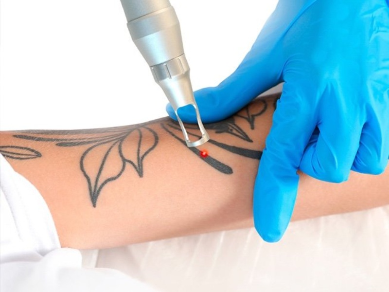 Xóa xăm bằng laser có để lại sẹo không - 2