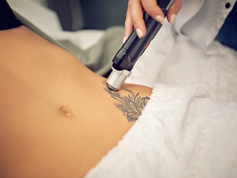 Xóa xăm bằng laser có để lại sẹo không - 4