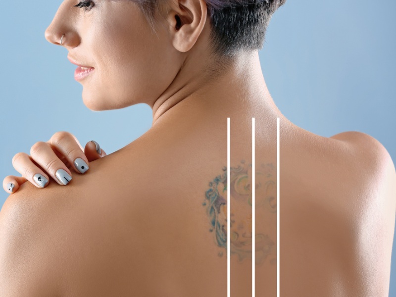 xóa xăm bằng laser có hại không - 5