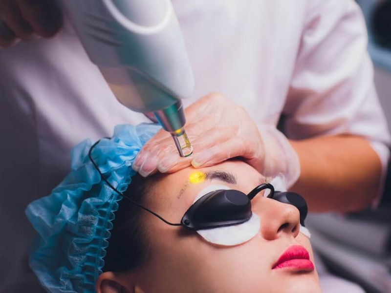 Xóa xăm chân mày bằng laser - 1