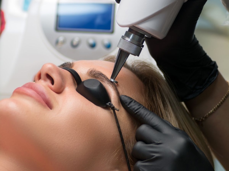 Xóa xăm chân mày bằng laser - 2