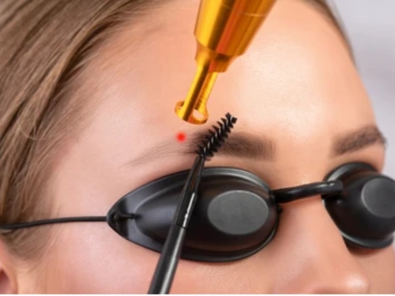 Xóa xăm chân mày bằng laser - 3