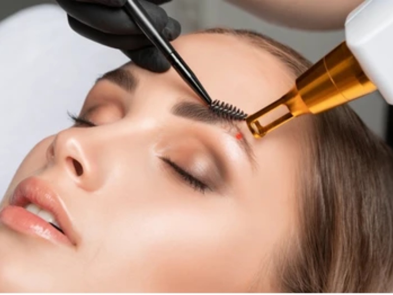 Xóa xăm chân mày bằng laser - 4