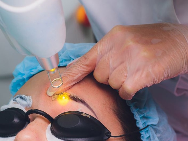 Xóa xăm chân mày bằng laser - 5