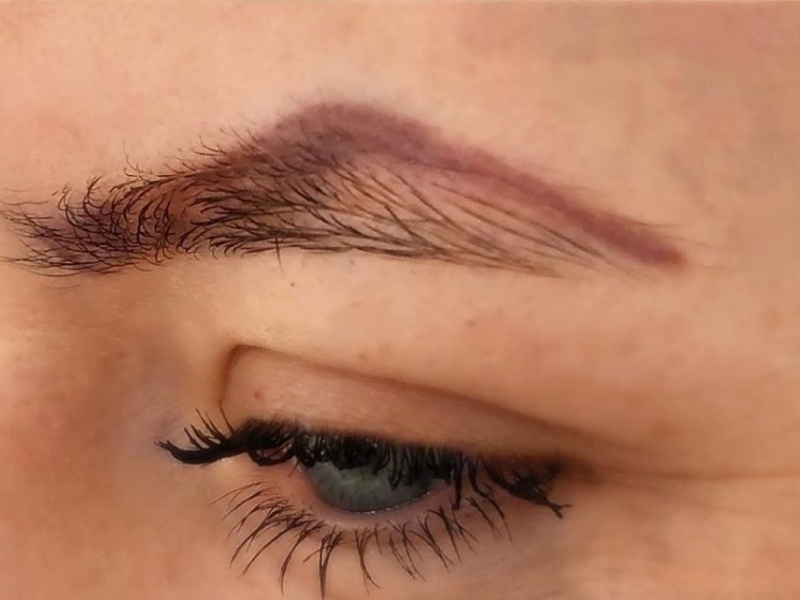 Xóa xăm chân mày bằng laser - 7