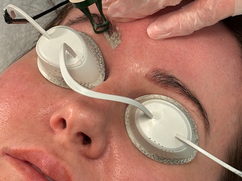 Xóa xăm chân mày bằng laser - 8