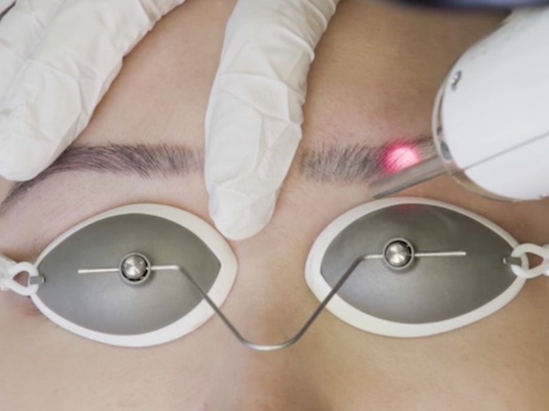 Xóa xăm chân mày bằng laser - 9