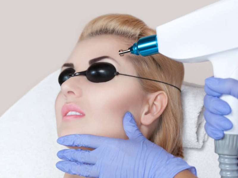 Xóa xăm lông mày bằng laser giá bao nhiêu - 3