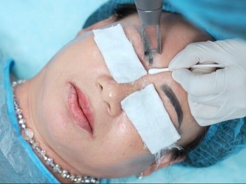 Xóa xăm lông mày bằng laser giá bao nhiêu - 4
