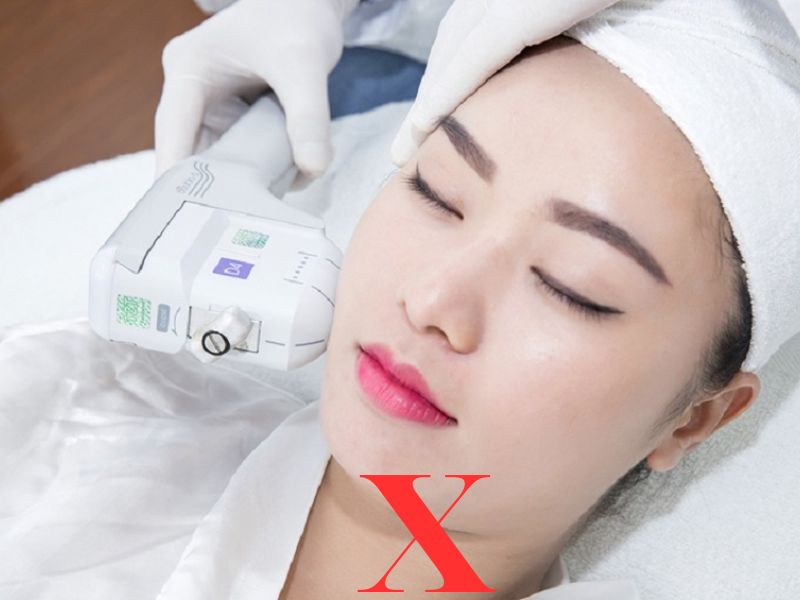 Bắn IPL trị thâm - 6