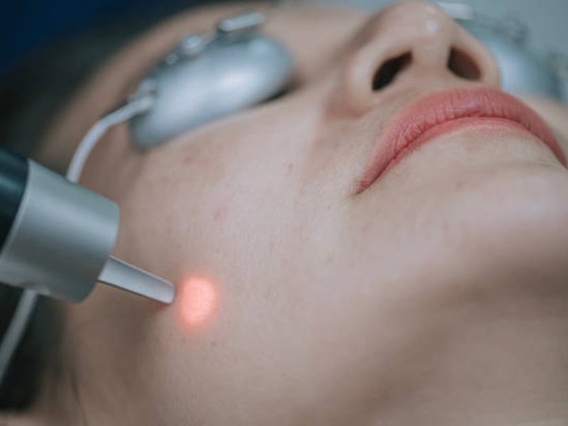 Bắn laser bao lâu thì hết thâm - 5