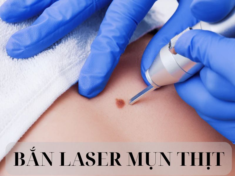 Bắn laser mụn thịt - 1