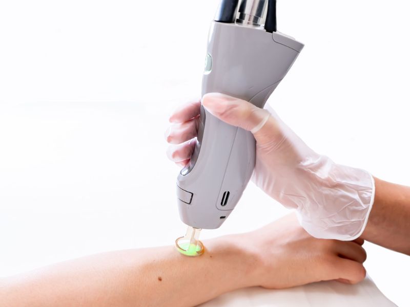 Bắn laser mụn thịt - 9