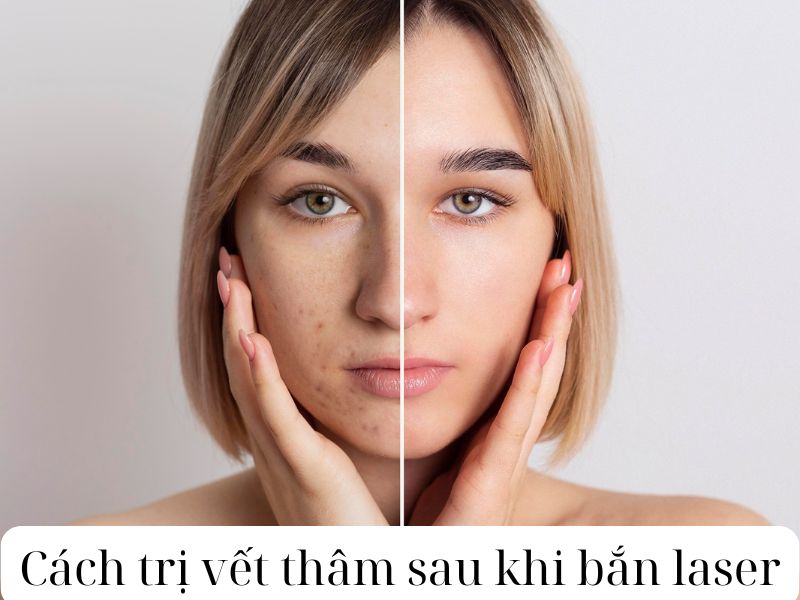 Cách trị vết thâm sau khi bắn laser - 1