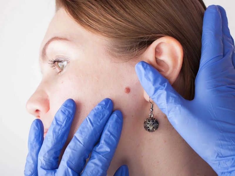 Chăm sóc sau khi tẩy nốt ruồi bằng laser -5