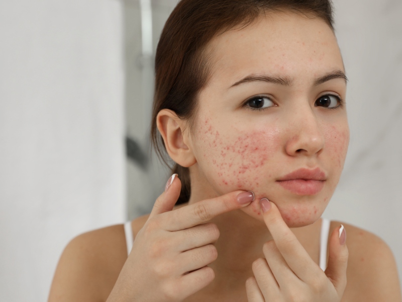 Công nghệ ipl trị mụn - 1