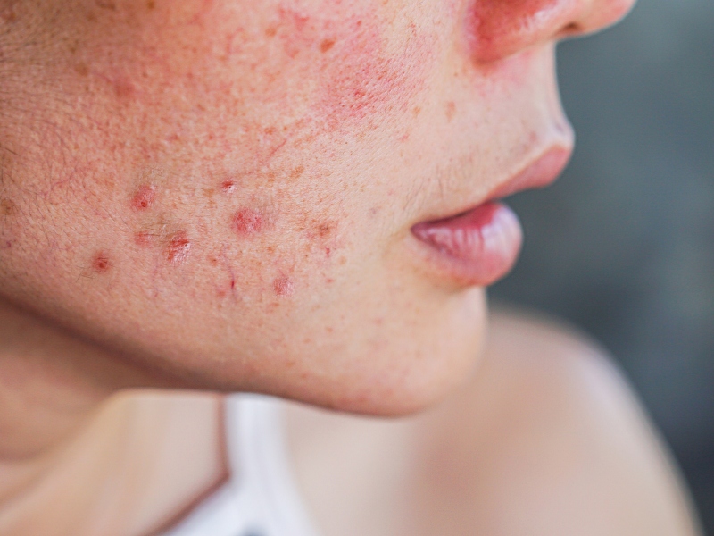 Công nghệ ipl trị mụn - 2