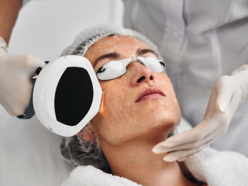Công nghệ ipl trị mụn - 3