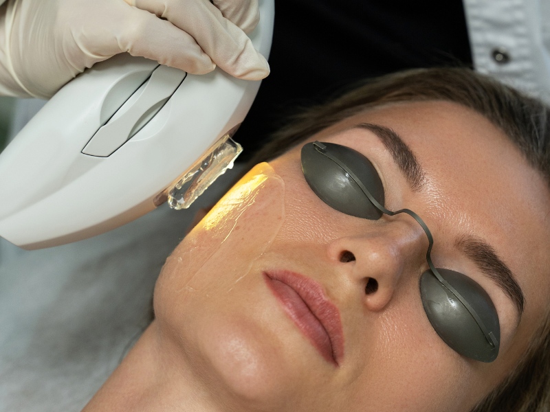 Công nghệ ipl trị mụn - 5