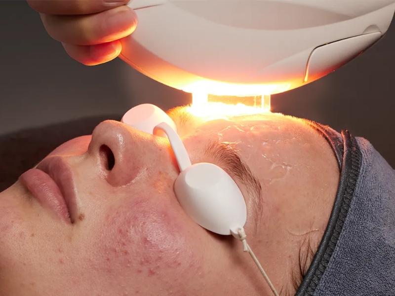 Công nghệ ipl trị mụn - 6