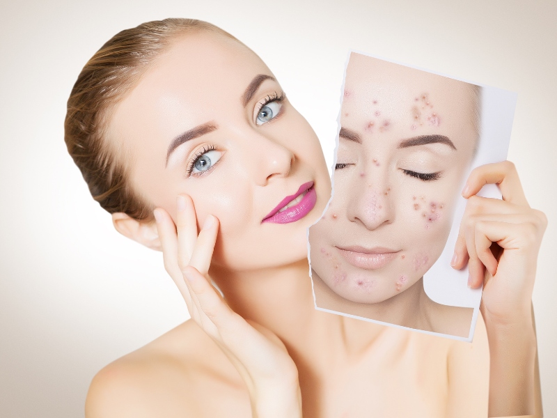 Công nghệ ipl trị mụn - 7