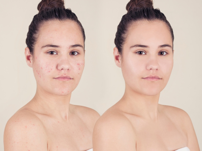 Công nghệ ipl trị mụn - 8