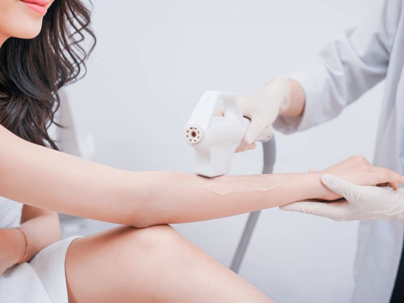 Điều trị giãn mao mạch bằng IPL - 12