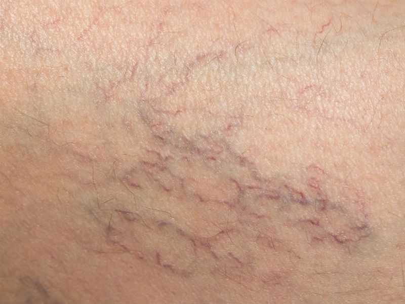 Điều trị giãn mao mạch bằng IPL - 2