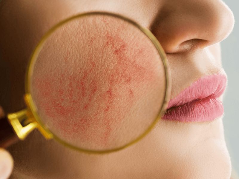 Điều trị giãn mao mạch bằng IPL - 4