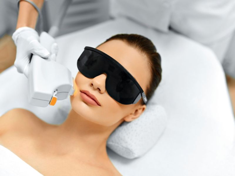 Điều trị giãn mao mạch bằng IPL - 5