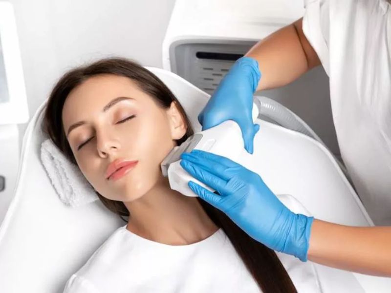 Điều trị giãn mao mạch bằng IPL - 6