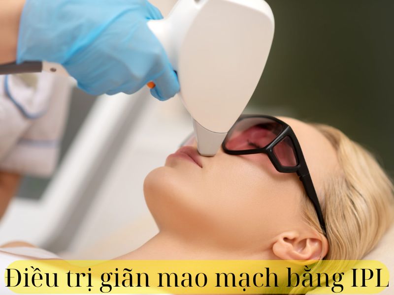 Điều trị giãn mao mạch bằng IPL - 1