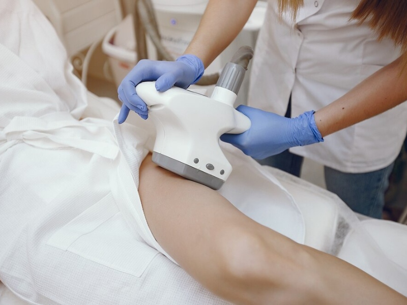 Điều trị giãn mao mạch bằng laser - 3