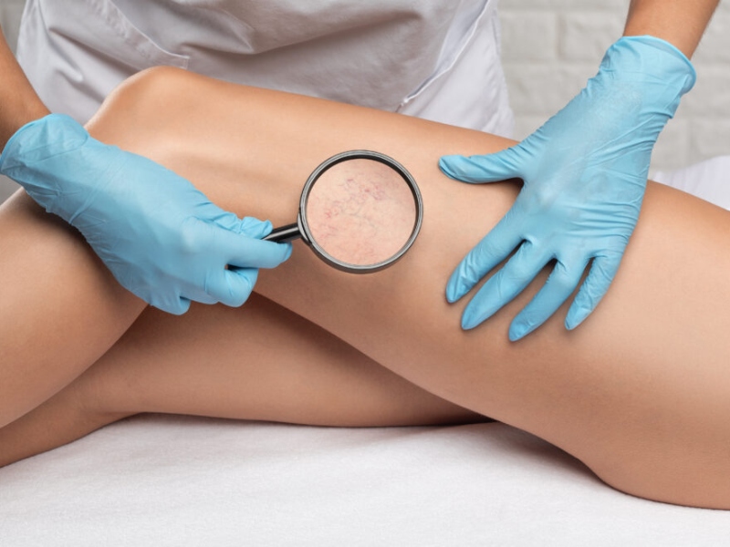 Điều trị giãn mao mạch bằng laser - 8