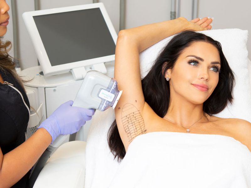 Điều trị hôi nách bằng laser - 3