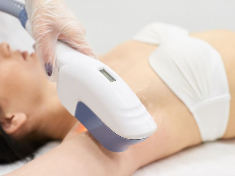 Điều trị hôi nách bằng laser - 7