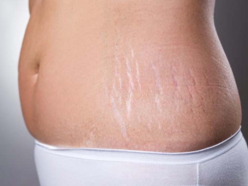 Điều trị rạn da bằng laser - 1