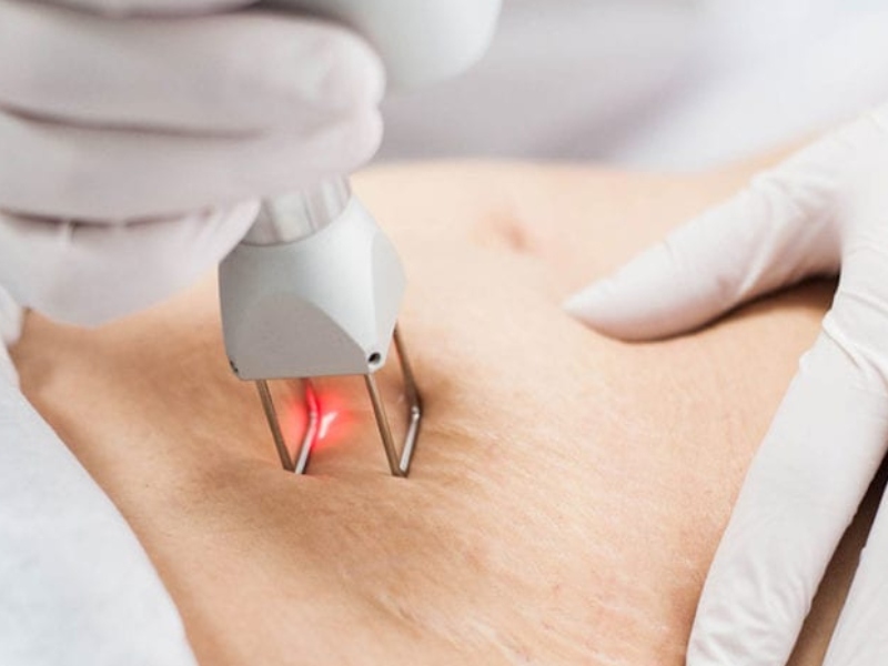 Điều trị rạn da bằng laser - 2