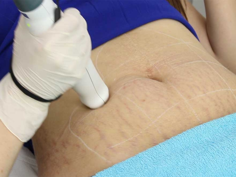 Điều trị rạn da bằng laser - 3