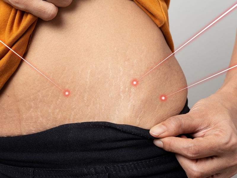 Điều trị rạn da bằng laser - 5