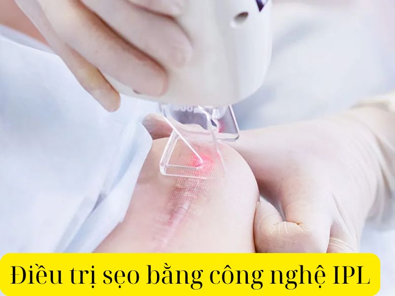 Điều trị sẹo bằng công nghệ IPL - 1